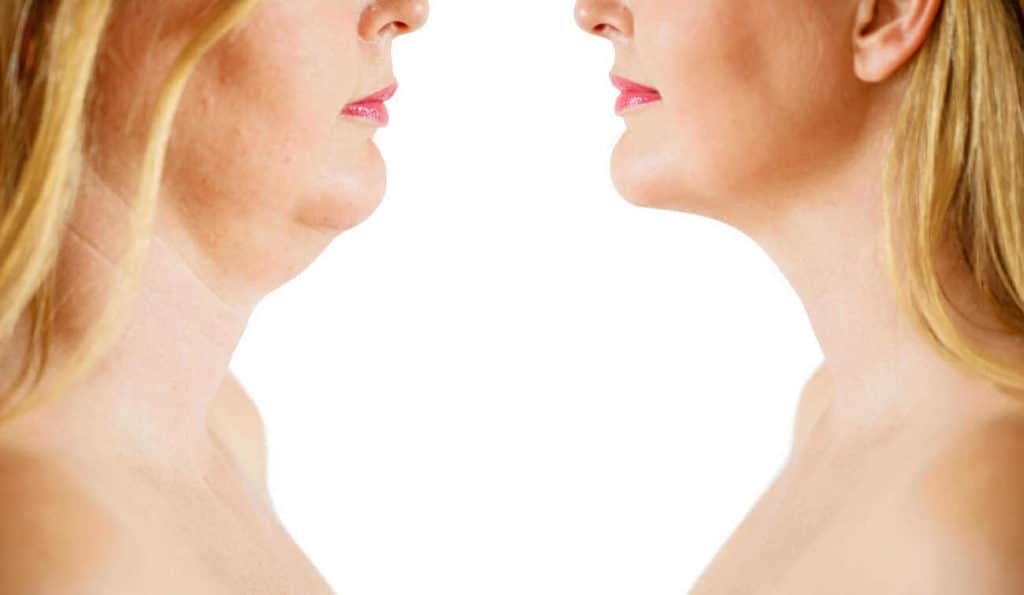 Double Chin treatment Ilford before and after results