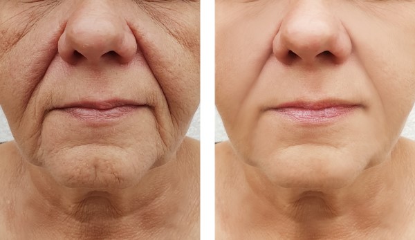 Learn more about Morpheus8 Treatment Ilford today!