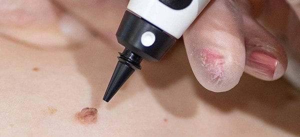 After Skin Tag Removal Ilford
