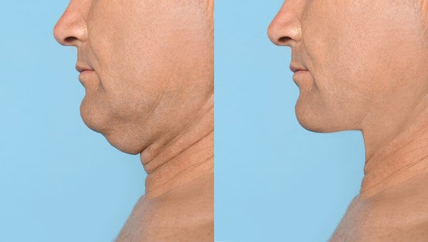 Which Non-Surgical Treatments Work Best for Jowls and Loose Skin Ilford?