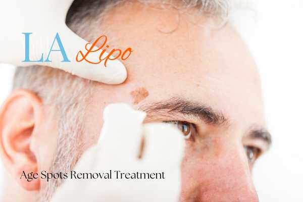 What Are the Most Effective Treatments for Age Spots Ilford?