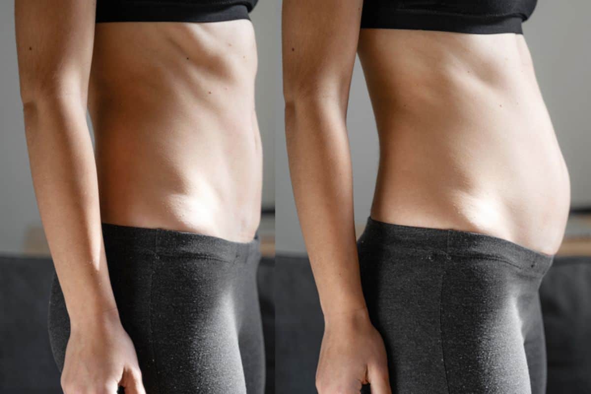 How long does diastasis recti take to improve Ilford?