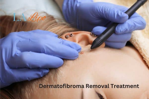Dermatofibroma Removal Treatment Ilford
