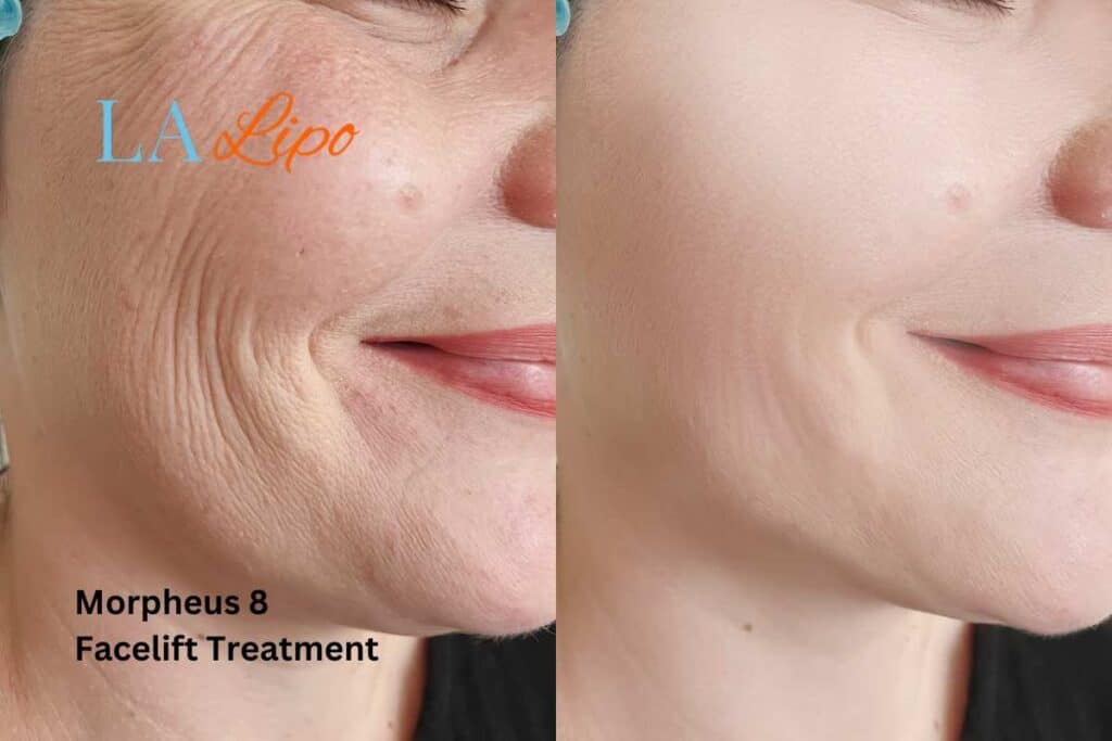 Morpheus8 Treatment Ilford for flawless skin! Call us today!