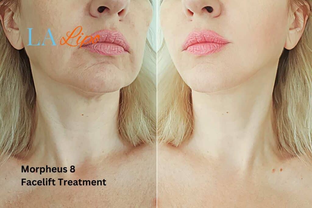 Turn back time with Morpheus8 Treatment Ilford