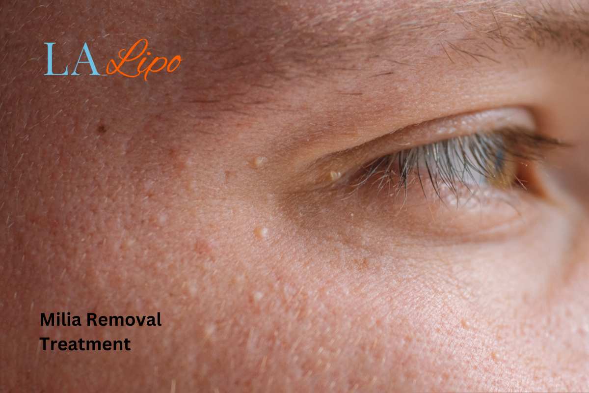 Cryopen Milia Removal: Is It the Easiest and Safest Option Ilford?