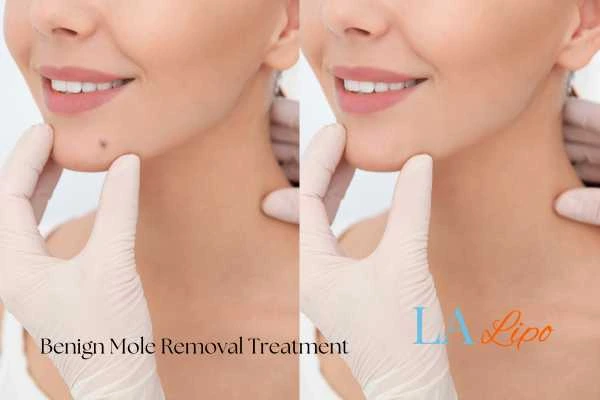 Before-and-after results following benign mole-removal treatment Ilford