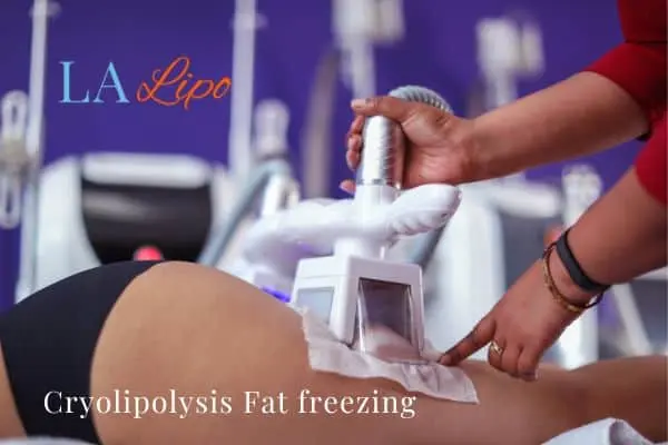 women getting fat freezing Ilford