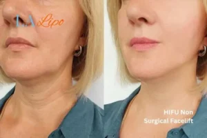 hi-fu for wrinkles Ilford before and after results