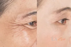 Before and after results of woman - HI-fu wrinkles reduction treatment Ilford