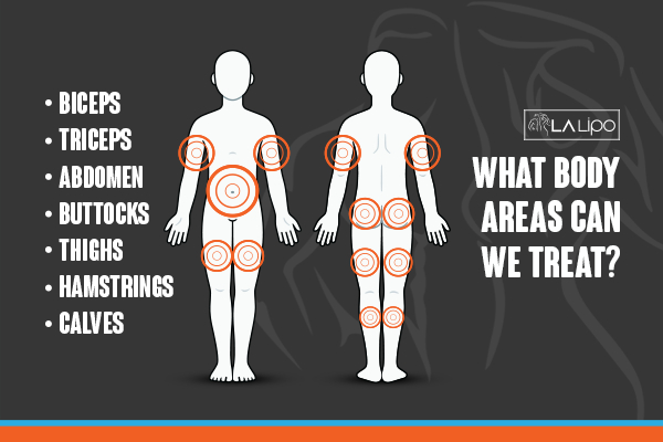 Graphic to show areas you can have LA-EMS Body Sculpting Ilford treatment.
