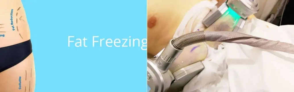 Fat freezing Ilford on multiple areas of the body