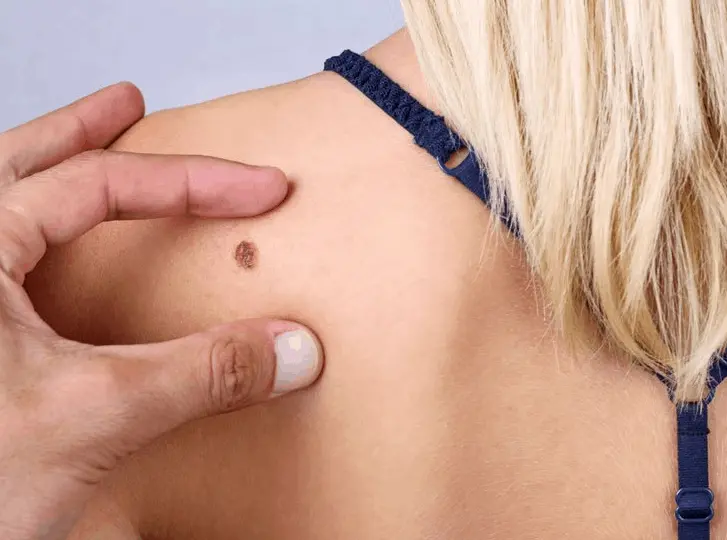 woman having mole removal Ilford consultation before treatment.