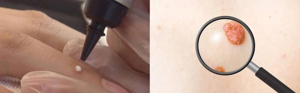 CryoPen practitioner Ilford assessing a benign mole before treatment
