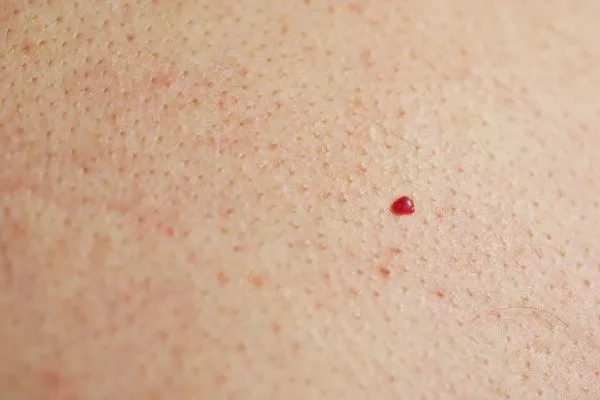 close up of a cherry angioma Ilford