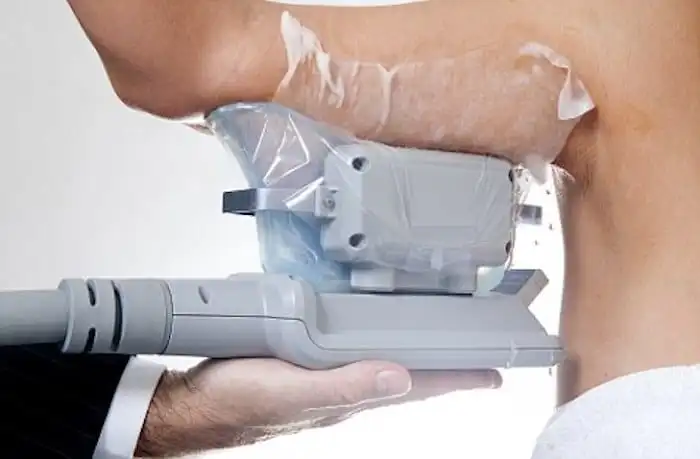 Picture of fat freezing Ilford on the upper arms.