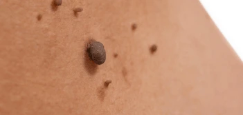 image of a skin tag Ilford