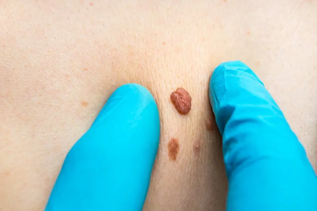 Consultant examining a skin tag Ilford