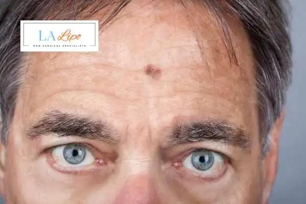 Solar Lentigo Removal Ilford image of man with mark on his forehead