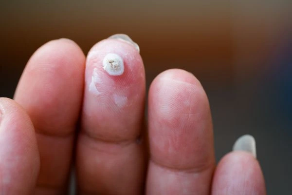 wart on person finger - cryotherapy to treat from LA LIPO Ilford
