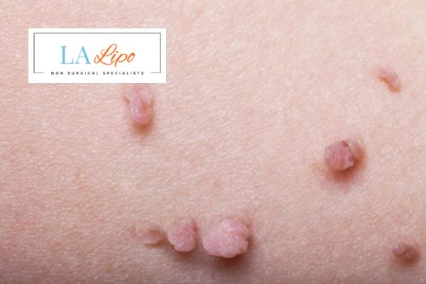 Does cryopen skin tag removal Ilford hurt? Find out now call our team today!