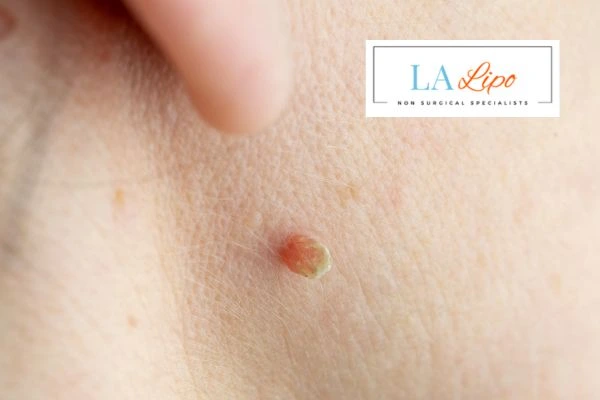 Book skin tag removal Ilford today speak to our team now!