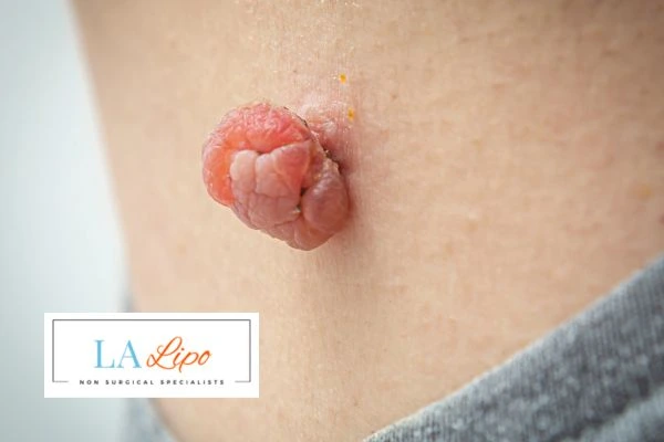 Interested in skin tag removal Ilford? Concerned about the pain? Find out more today!