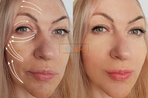 Morpheus 8 results Ilford face lift.