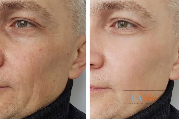 See the amazing results of Morpheus8 Treatment Ilford!