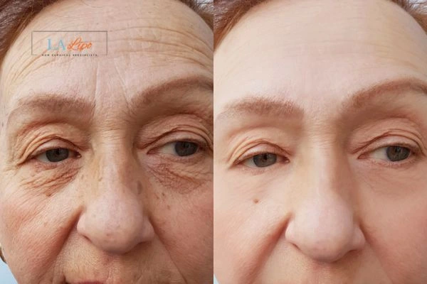 The powerful benefits of Morpheus8 Treatment Ilford - Call Our team today!