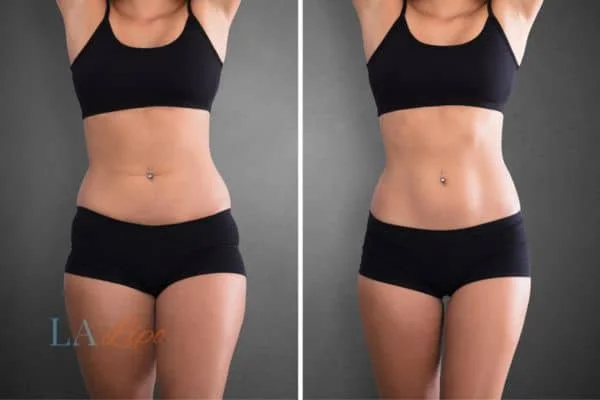 before and after results of non-surgical treatment to help a woman's body image and mental health Ilford