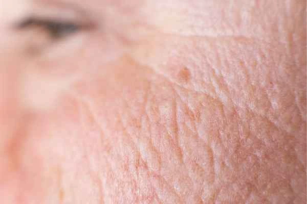 close up picture of a woman's face showing an age spot Ilford