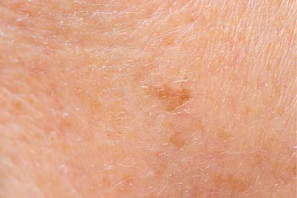 close up picture of age spots Ilford