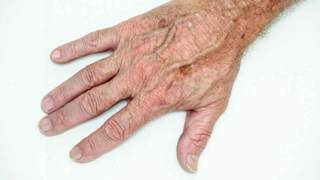 Male hand showing age spot Ilford