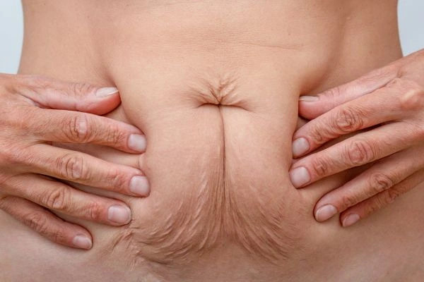 Should I Combine Diastasis Recti Treatment with Body Contouring for Better Results Ilford?