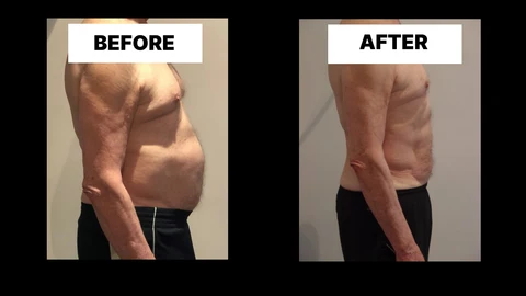 What Symptoms Can Diastasis Recti Cause in Men? Weak Core, Back Pain and Poor Posture Ilford